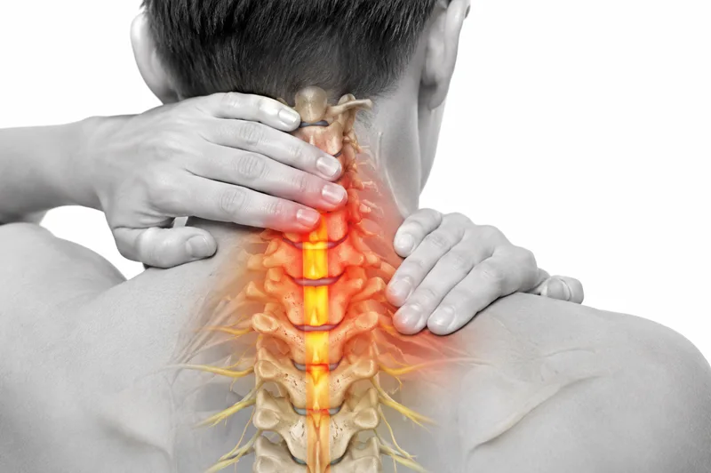 Mielopatía cervical